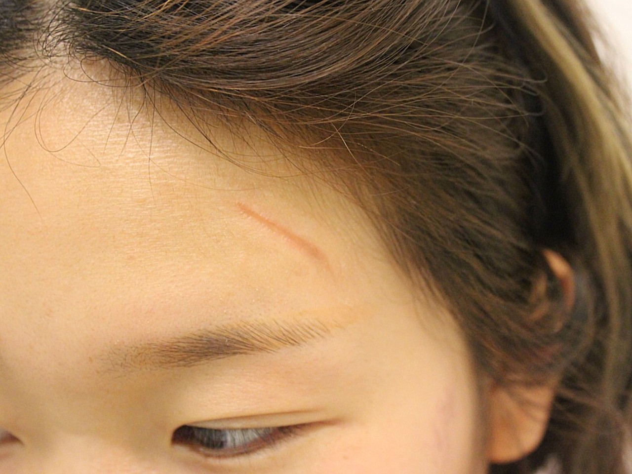 额头有伤疤的面相_额头有伤疤代表什么_额头有伤疤影响命运吗