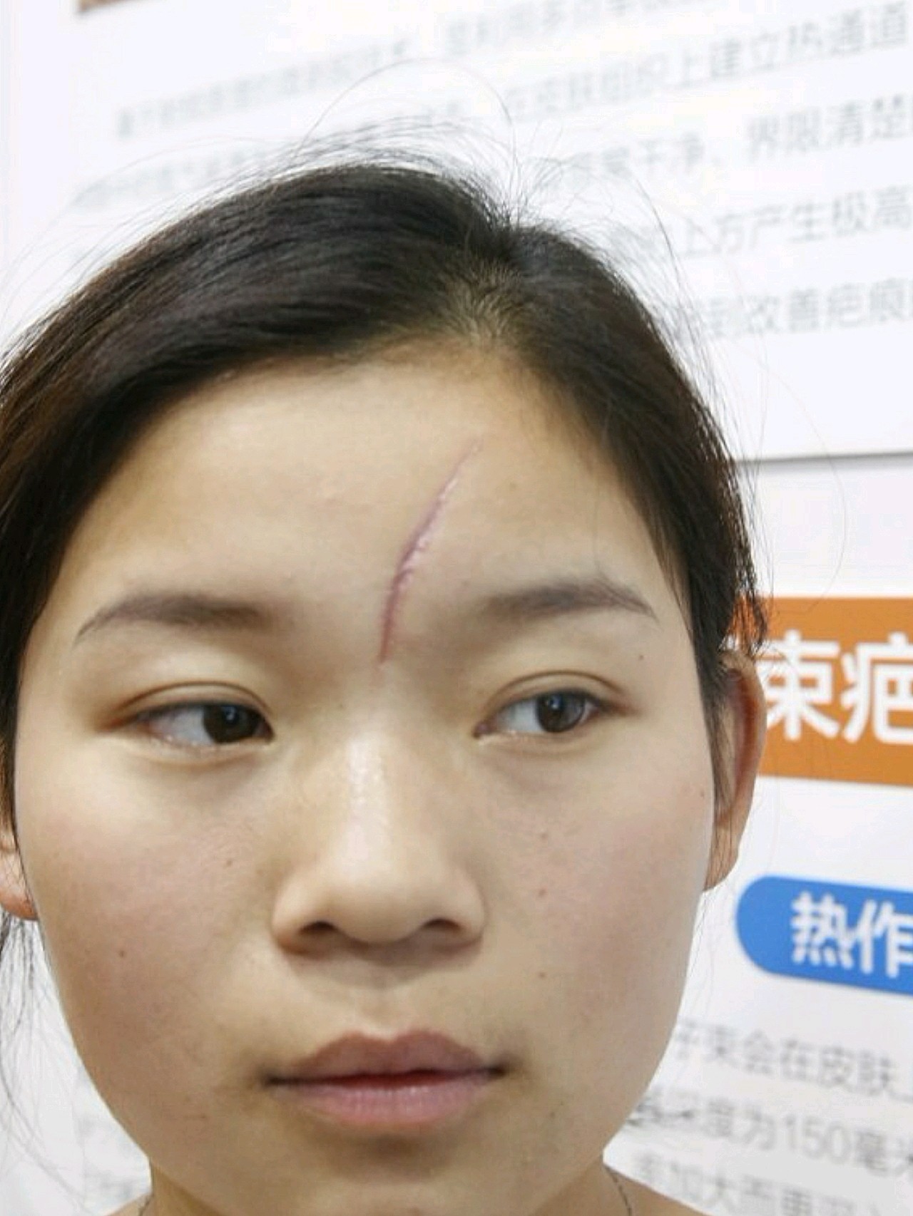 额头有伤疤的面相_额头有伤疤代表什么_额头有伤疤影响命运吗