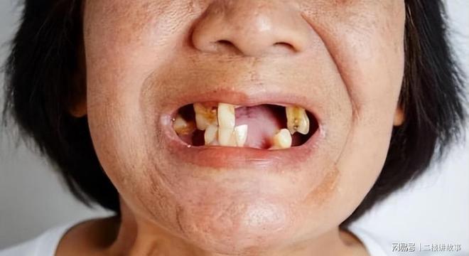 牙内陷是什么_牙齿内陷面相_牙齿内陷的女人