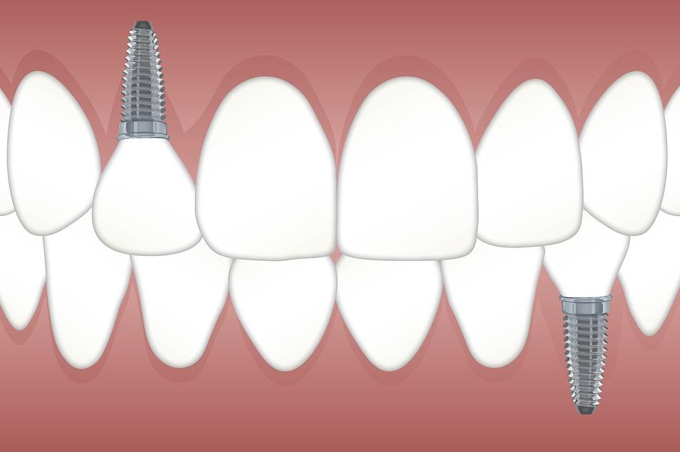 牙齿缺失时间越久，引发的问题就会越多！